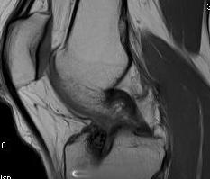 Revision ACL Pre MRI Sagittal